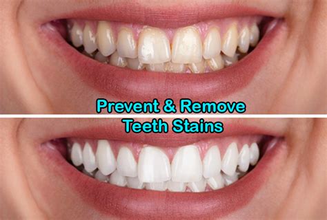 does honey stain teeth|can you stain teeth after eating.